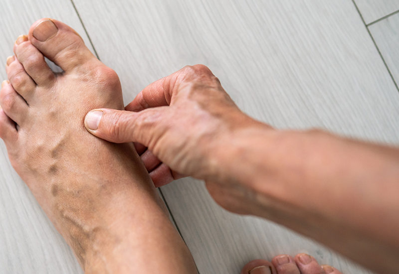 Get Relief from Bunion Pain with Expert Bunion Treatment in Redding
