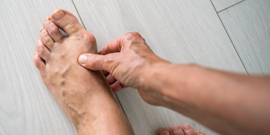 Get Relief from Bunion Pain with Expert Bunion Treatment in Redding